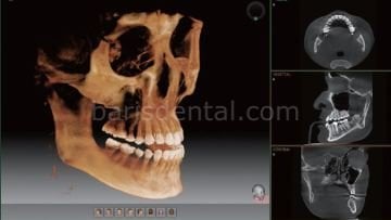Vatech PAX-İ3D Green Volumetrik Tomografi, Dijital Panoramik ve Sefalometrik Görüntüleme Cihazı