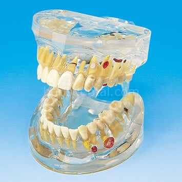 Şeffaf Diş Hastalıkları Modeli