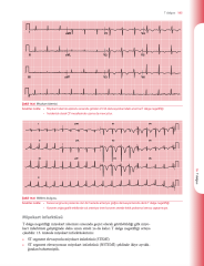 EKG'yi Anlamak (Uygulamalı Kılavuz)