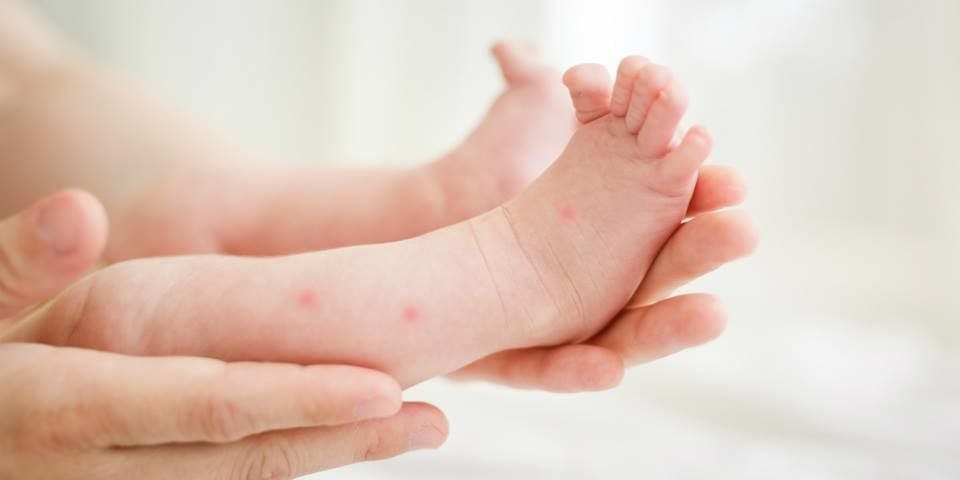 Bebeklerde Sivrisinek Isırığı