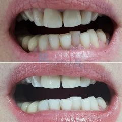 Pola Proffesional Endodontik Devital Beyazlatma Ajanı