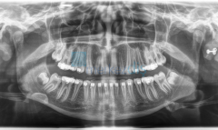 Orthophos E Panoramik Röntgen Cihazı