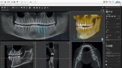 VistaVox S Dental Volumetrik Tomografi, Panoramik Röntgen Sistemi