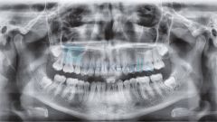 VistaVox S Ceph Dental Volumetrik Tomografi, Sefalometrik, Panoramik Röntgen Sistemi