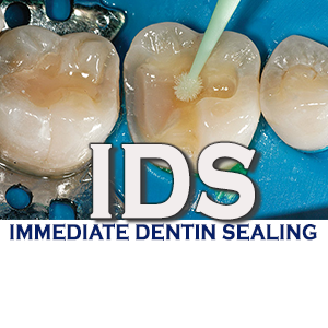 İmmediate Dentin Sealing (IDS) Tekniği