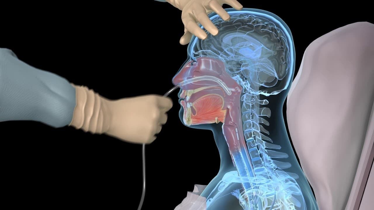 Nazogastrik Sonda: Klinik Uygulama, Çeşitleri, Yerleştirme ve Bakımı