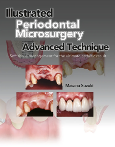 Illustrated Advanced Technique of Periodontal Microsurgery Soft tissue management for the ultimate esthetic result
