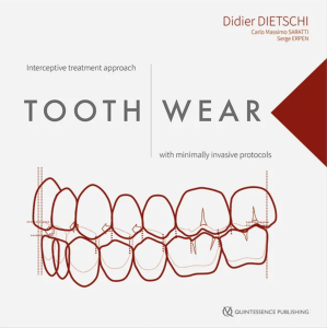 Tooth Wear Interceptive treatment approach with minimally invasive protocols