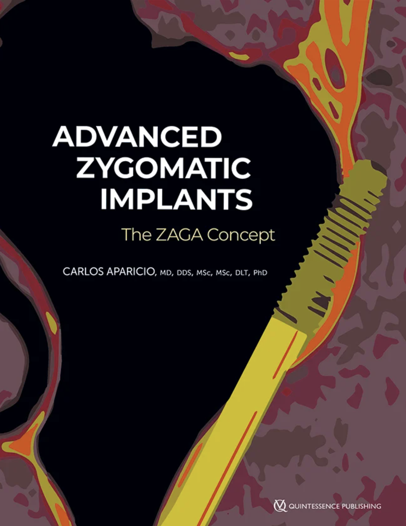 Advanced Zygomatic Implants - The ZAGA Concept