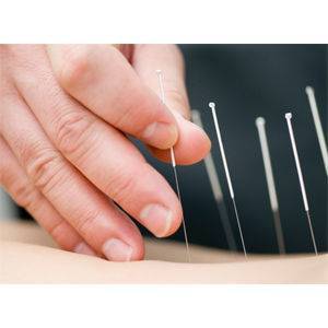 ShenLong Çelik Akupunktur İğnesi Kuru İğne 100 Adet