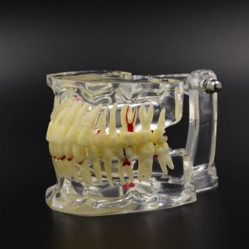 Pathology Tooth Çene Model