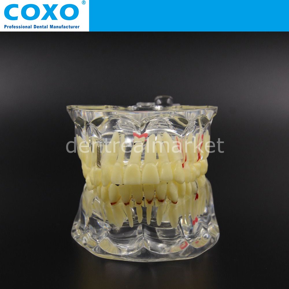 Pathology Tooth Çene Model