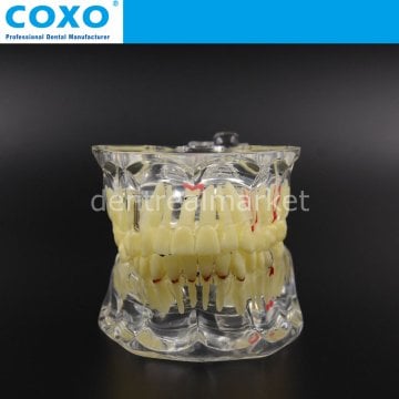 Pathology Tooth Çene Model