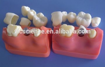 İmplant Diş Modeli