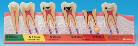 Caries Eğitim Modeli