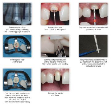 Dentolic Cam Fiber Post Set