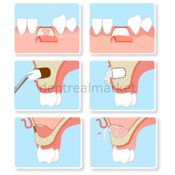 Parasorb Resodont Forte - Collagen Membran 64*25 mm - Kampanya ***