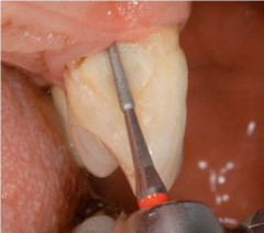 KLNK/ SET  Periodonti  FG, Periodont Set 2