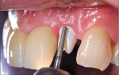 KLNK/ SET Ağız içi Zirkon Hazırlama FG, Intraoral Preparation set for Zirconia