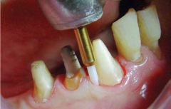 KLNK/ Tissue Trimmer, Trimmer Doku Şekillendirici FG