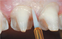 KLNK/ Tissue Trimmer, Trimmer Doku Şekillendirici FG