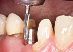 KLNK/ Titanyum Abutment şekillendirici, Tungsten Karbid Alet FG