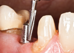 KLNK/ Titanyum Abutment şekillendirici, Tungsten Karbid Alet FG