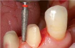 KLNK/ Chamfer Konik Torpil, Elmas Frez FG