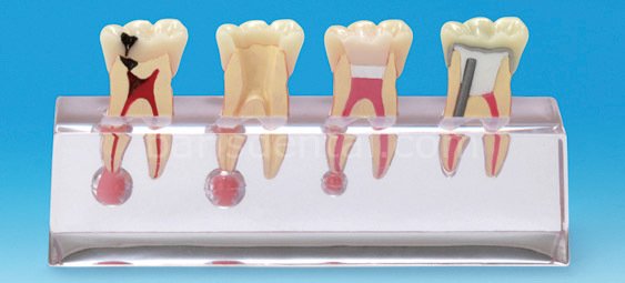 Hasta Eğitim Modeli / 4 Aşamalı Molar