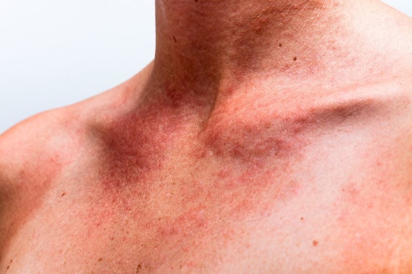 Güneş Lekesi Nedir? Ciltteki Güneş Lekesi Nasıl Geçer?