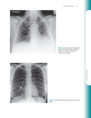 Akciğer Grafisini Anlamak