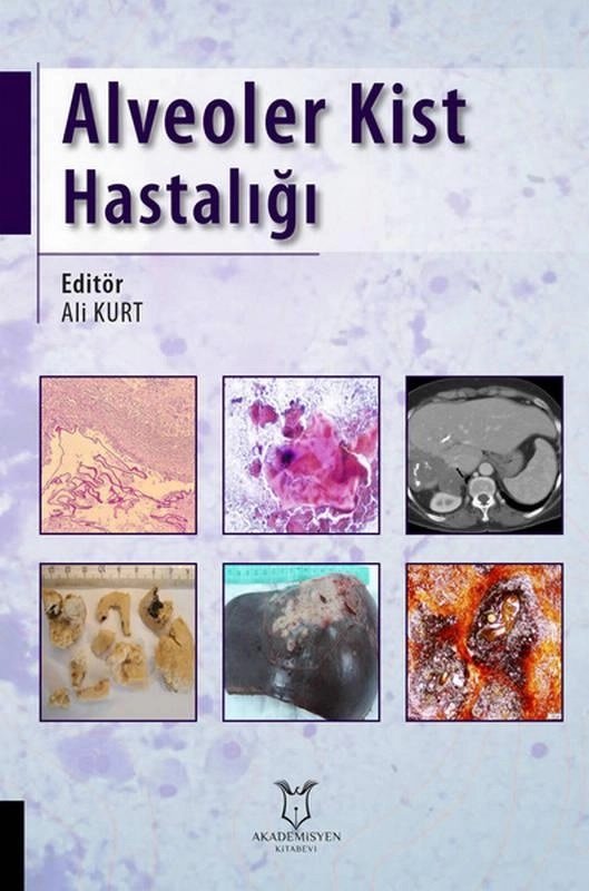 Alveoler Kist Hastalığı