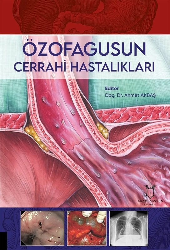 Özofagusun Cerrahi Hastalıkları