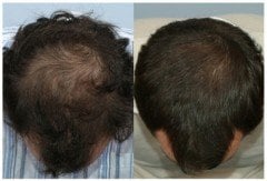 PN CELL  Anti Hair -Vitoxidil Saç Serum 5ml x 5 flakon