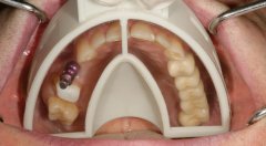 Miratray Implant Impression Tray, Lower I 1 (6 adet)