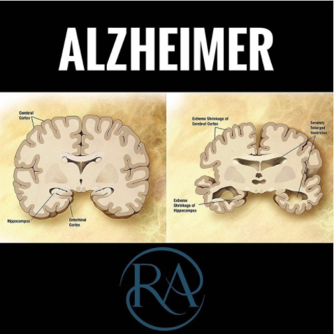 Alzheimer