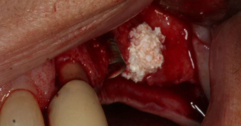 Parasorb Collagene Cone -  Çekim Soketi Koruma