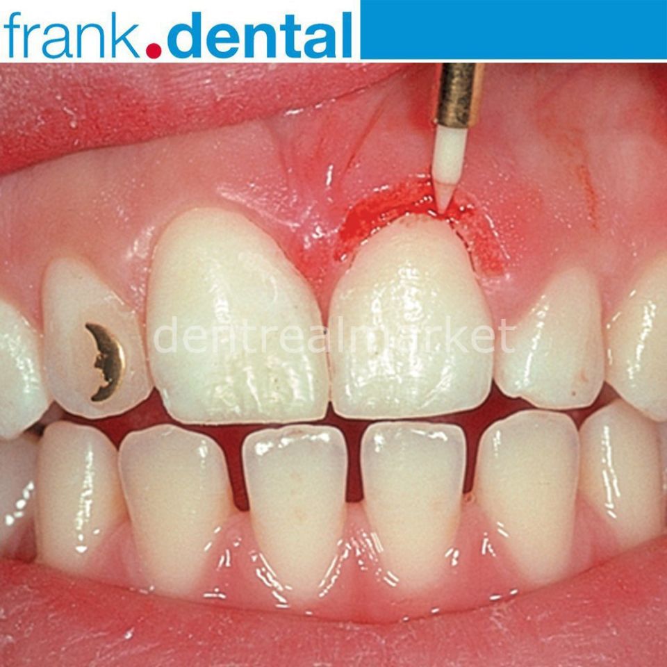 Gingiva Trimmer Yumuşak Doku Frezi - STT250