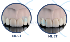 INDURATE Multilayer Extra-Translucent Zirkon Blok - 18 mm - %100 TOSOH