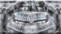 VistaVox S Dental Volumetrik Tomografi, Panoramik Röntgen Sistemi