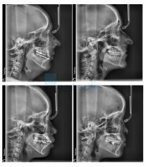 VistaVox S Ceph Dental Volumetrik Tomografi, Sefalometrik, Panoramik Röntgen Sistemi