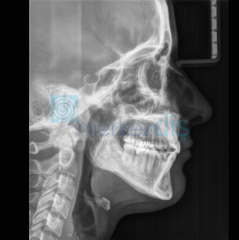 Orthophos E Ceph Panoramik ve Sefalometrik Röntgen Cihazı