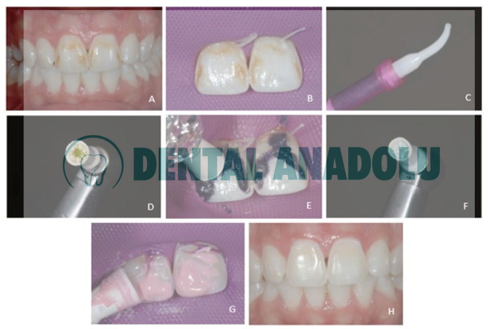 Ultradent Opalustre Florozisli Dişler İçin Beyazlatma