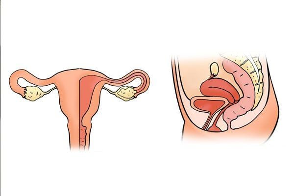 Çikolata Kisti Nedir? Belirtileri Nelerdir? Zararları, Bitkisel Tedavisi 