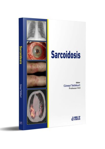 Sarcoidosis