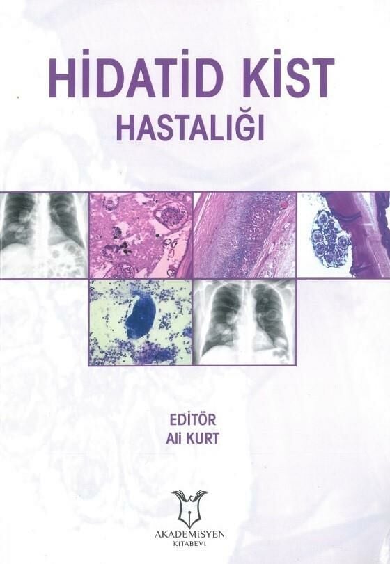 Hidatid Kist Hastalığı