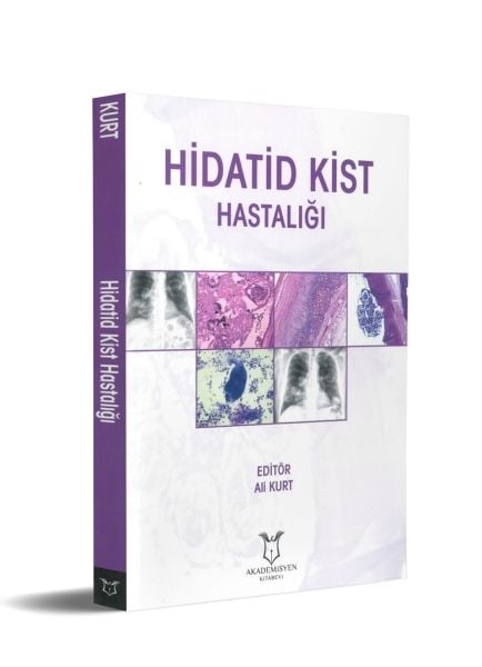 Hidatid Kist Hastalığı