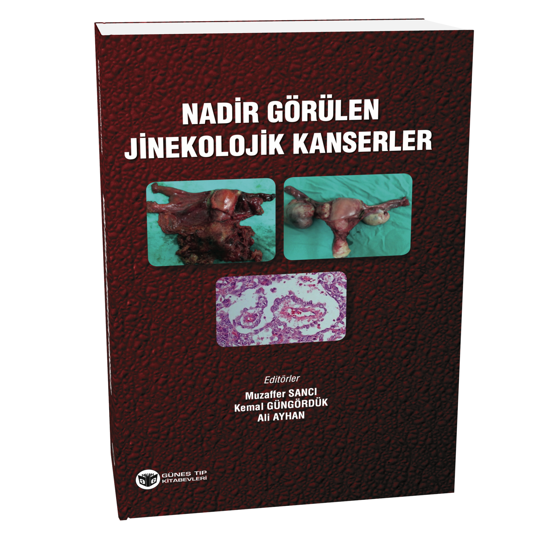 Nadir Görülen Jinekolojik Kanserler