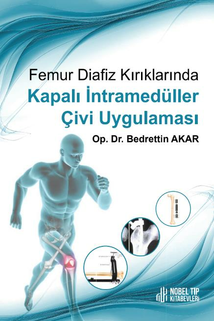 Femur Diafiz Kırıklarında Kapalı İntramedüller Çivi Uygulaması