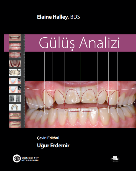 Gülüş Analizi